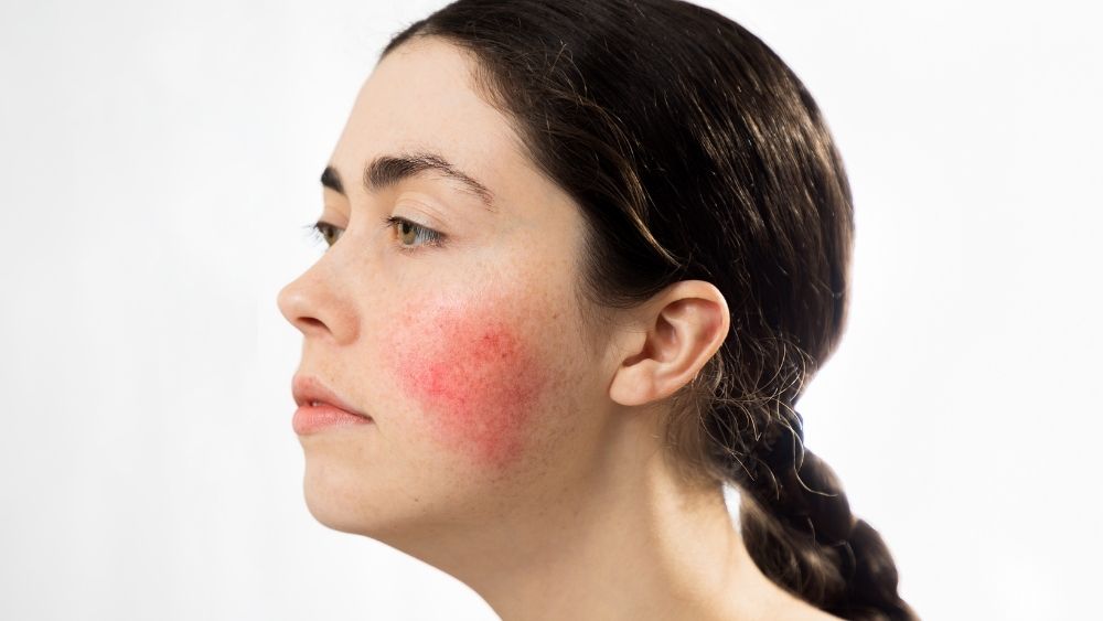 rosacea treatment